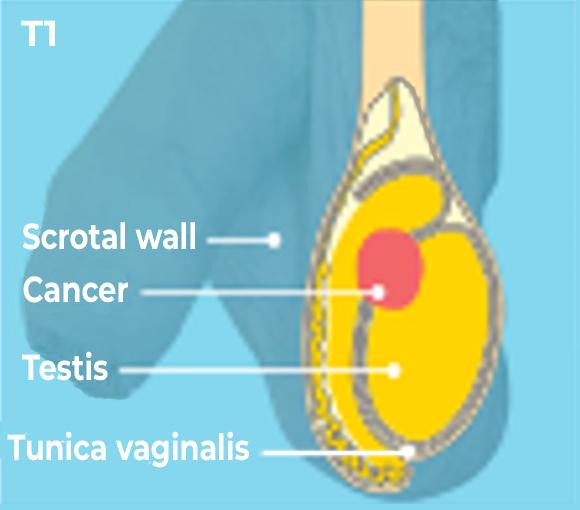 Tumours in testicle level 1